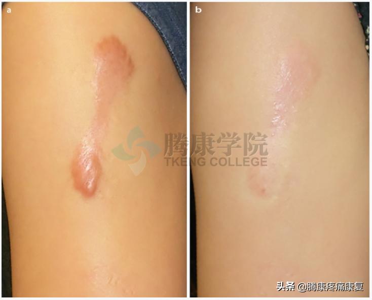 皮质类固醇贴剂治疗瘢痕疙瘩,类固醇激素治疗疤痕增生