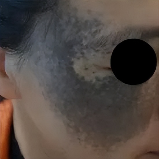 新生儿有胎记,新生儿身上有胎记怎么处理