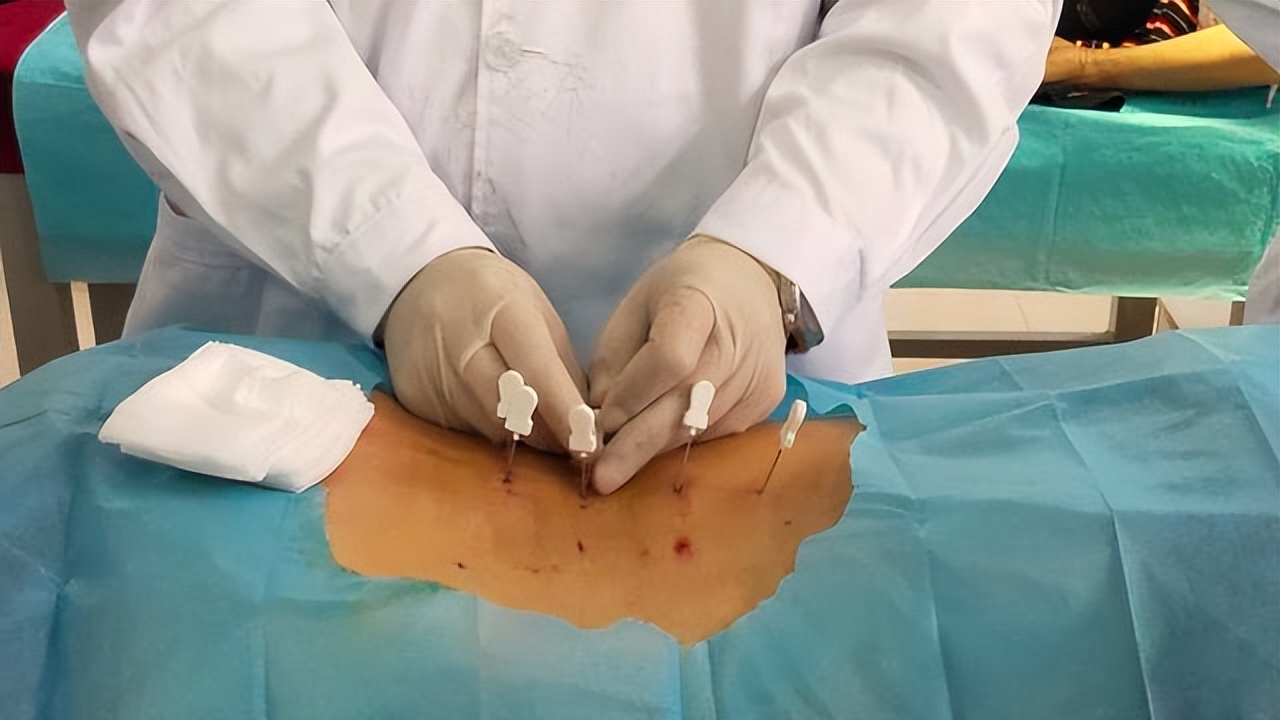 彻底治好腰椎间盘突出的方法,各种腰椎间盘突出治疗方法的弊端