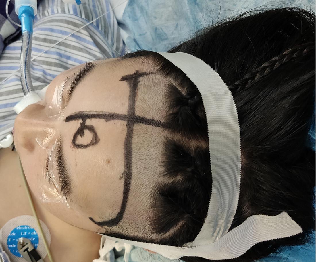 动脉瘤蛛网膜下腔出血术后并发症,动脉瘤导致蛛网膜下腔出血严重吗