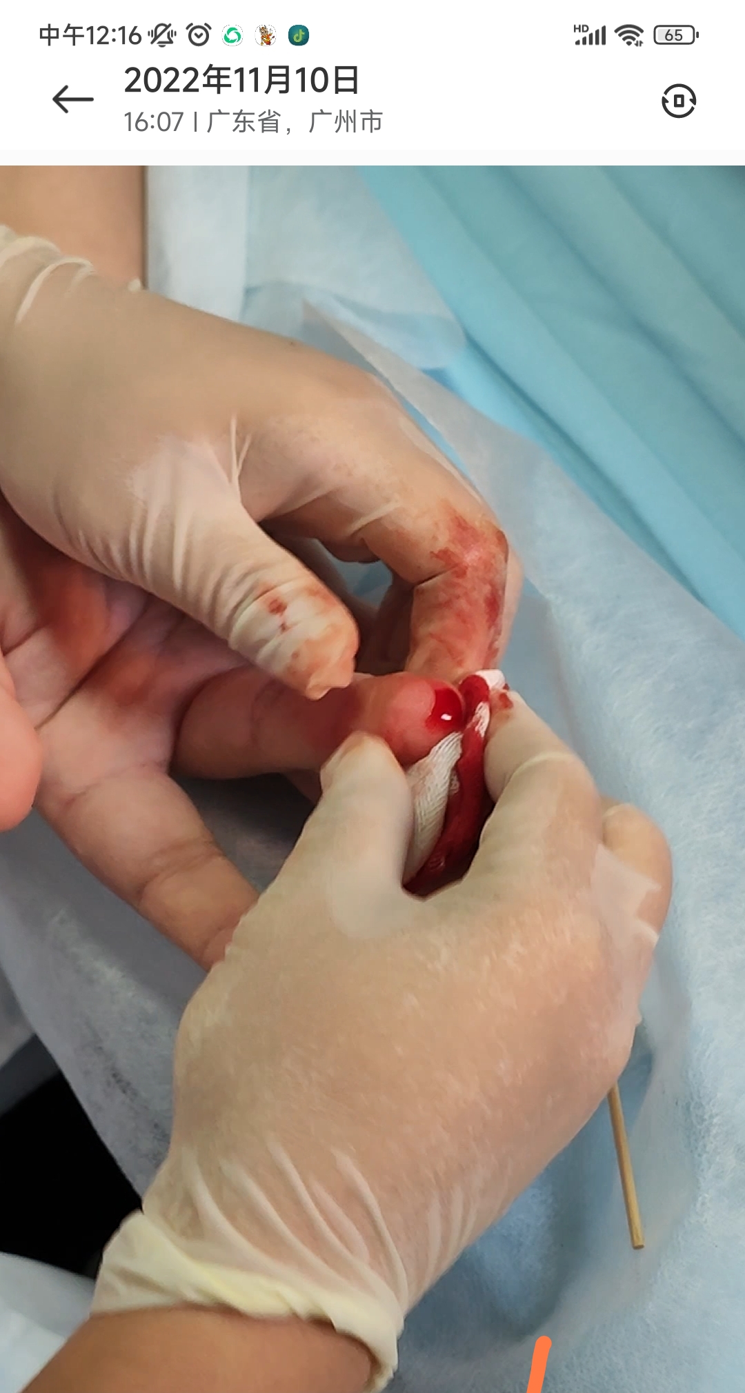 右丘脑出血出现偏瘫说不出来话,脑卒中走路不稳能恢复吗