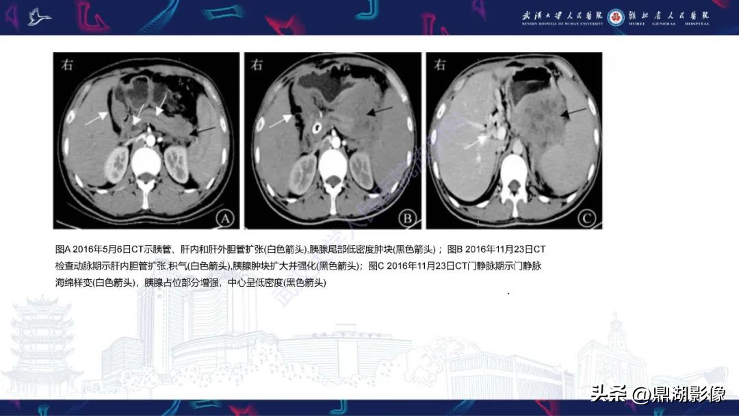 阴道肉瘤症状,阴道肉瘤的早期症状