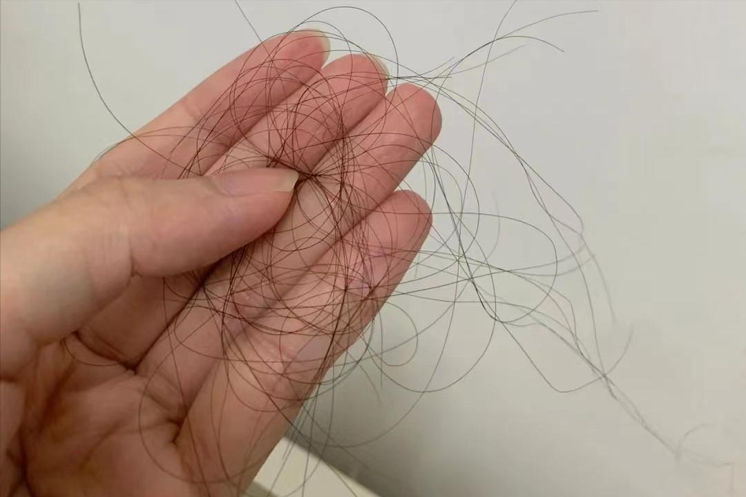 使用米诺地尔两个月长头发,使用米诺地尔五个月照片