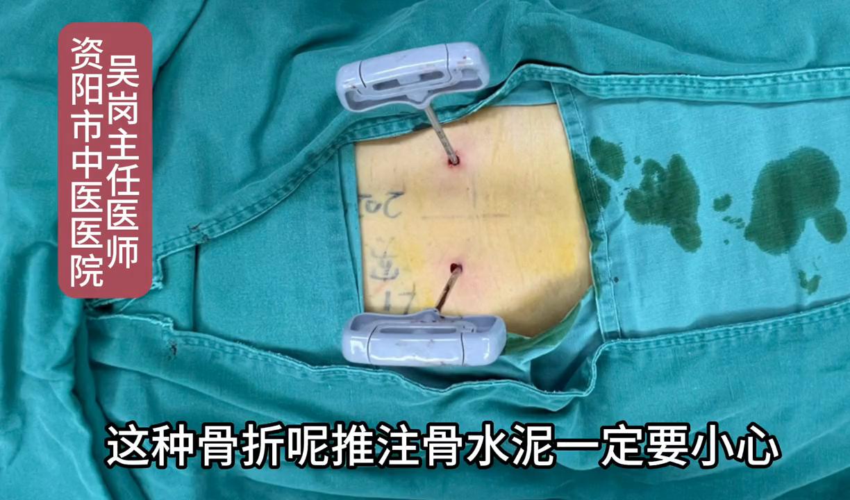 腰椎受伤造成压缩性骨折怎样治疗,腰椎骨折哪种情况适用于微创手术