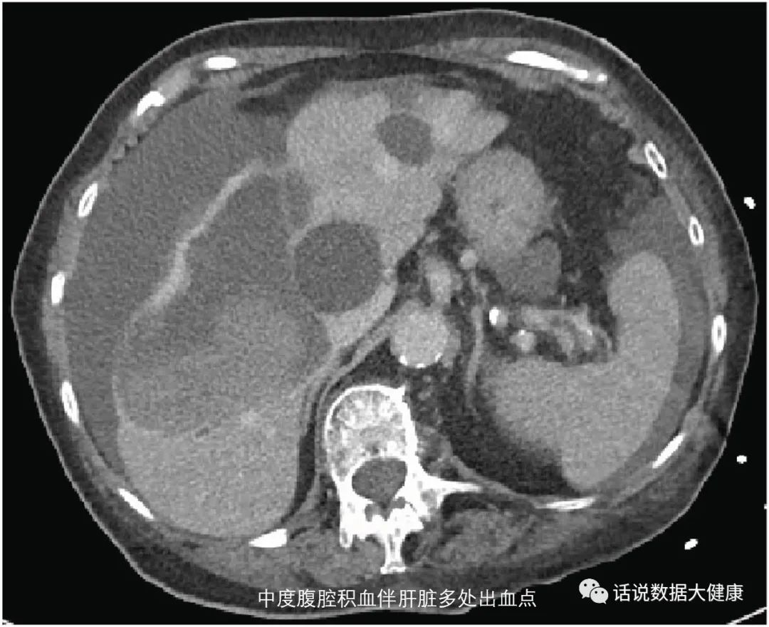 保健纳豆能长期吃吗,保健食品纳豆激酶