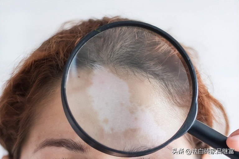 初期白斑多长时间就严重了,初期白斑病较好的治疗方法