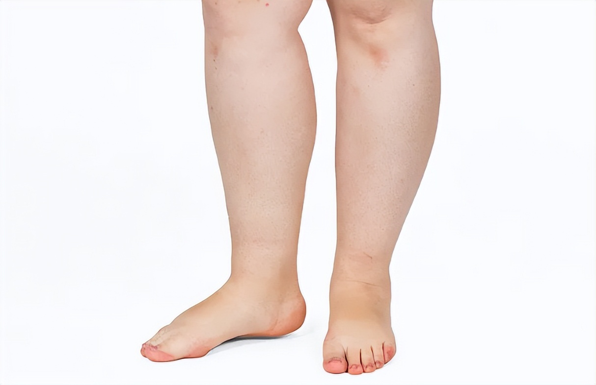 水肿是不是肾病严重了,水肿是左心衰还是右心衰