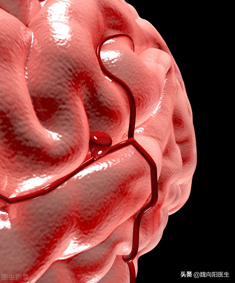 蛛网膜下腔出血简单确诊,蛛网膜下腔出血最有效的检查方法