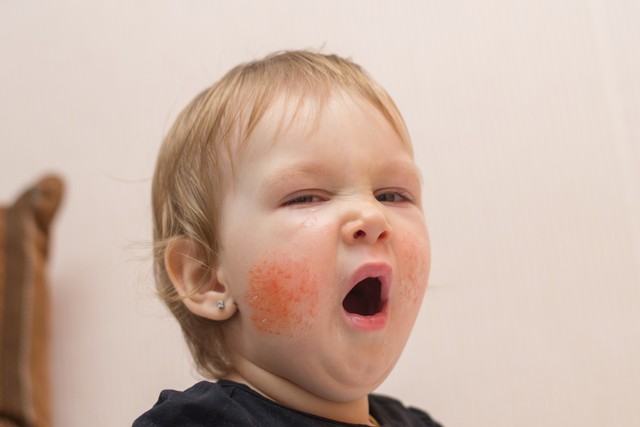 新生儿湿疹可以用黄金菊护理膏吗,宝宝湿疹怎么办最有效的方法