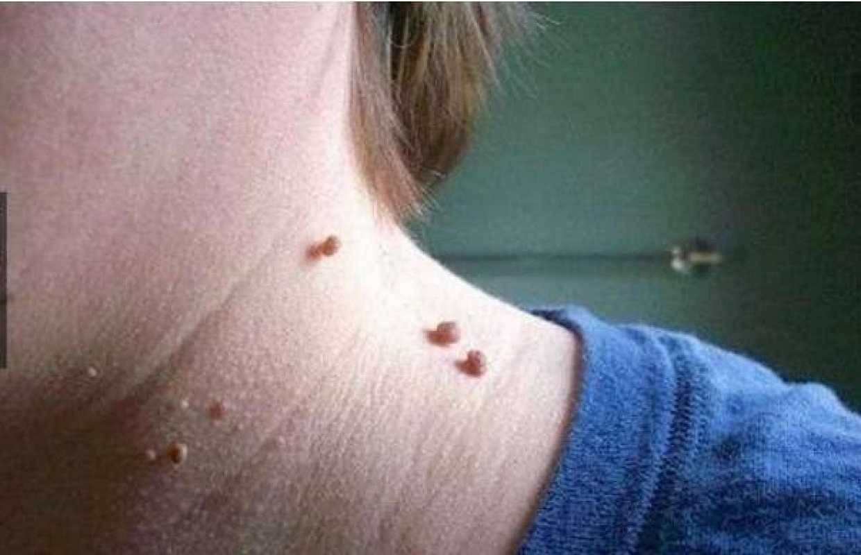 脖子上长小肉粒有什么办法治疗吗,脖子上长小肉粒会治愈么