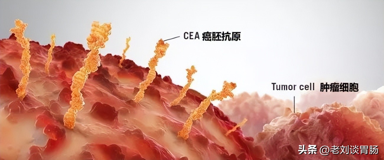 肺癌会导致癌胚抗原升高吗,胆囊炎会使癌胚抗原升高吗