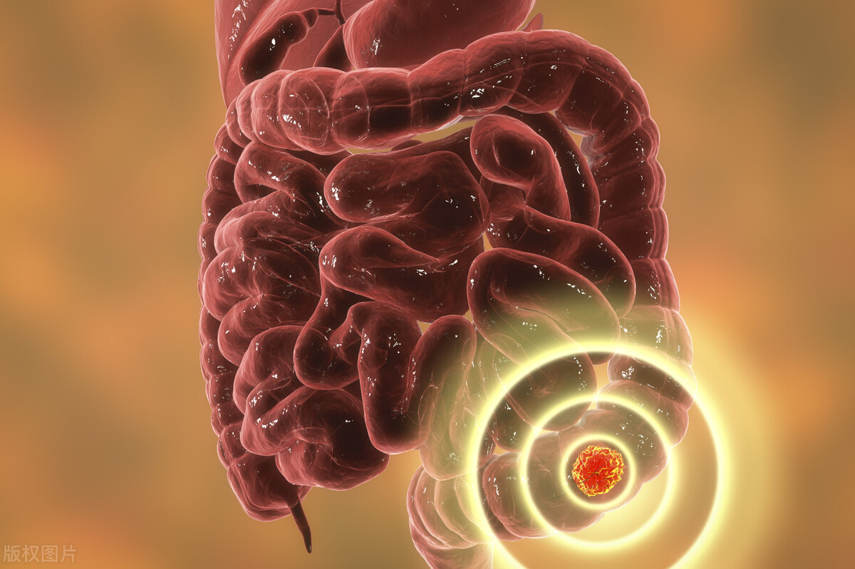 直肠癌晚期一般有什么症状？