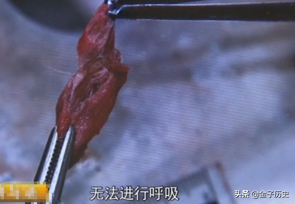 3岁男孩补牙途中意外身亡,3岁男孩补牙死亡