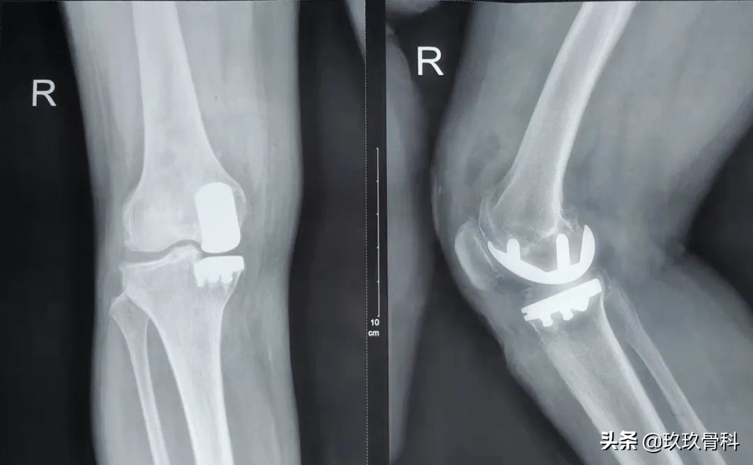 力达康XU单髁假体治疗“双膝”骨性关节炎——贵阳东方骨科医院