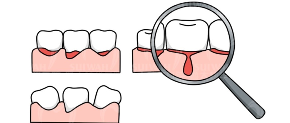 中山大学附属口腔医院牙缝修复,苏州华夏口腔修复牙缝