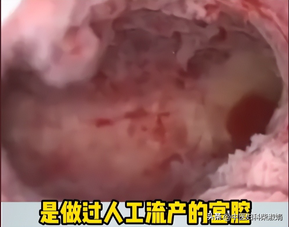 一组图，揭秘人流后的子宫状态，结果太直观了
