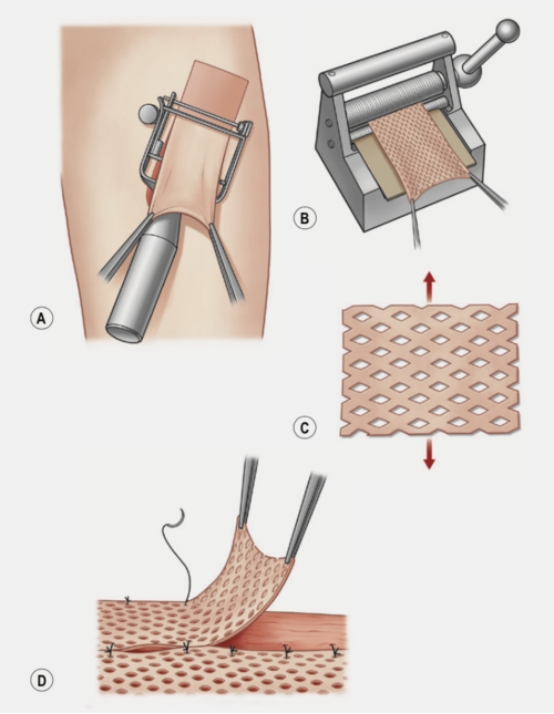 烧伤患者创面处理,烧伤创面处理的原则主要是