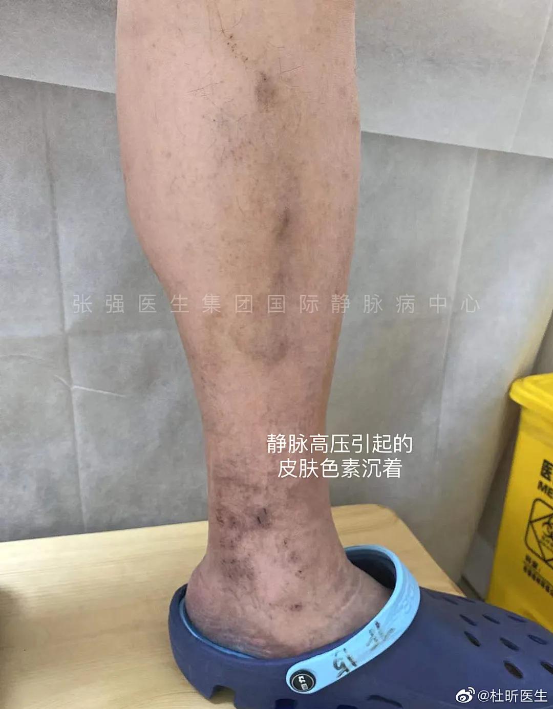 有静脉曲张的人可以每天泡脚吗,有静脉曲张的人能用热水泡脚吗