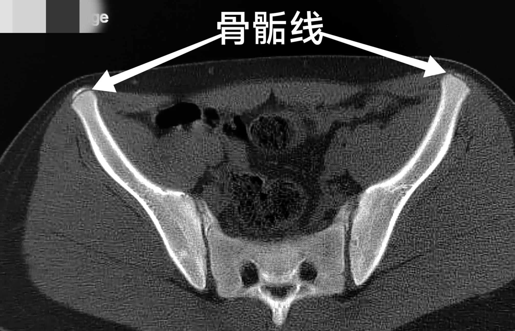 跑完步发现膝盖剧痛怎么办,跑完步为什么腿里有根筋痛