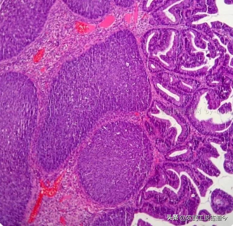 宫颈活检结果和锥切病理结果区别,宫颈活检结果报告减号