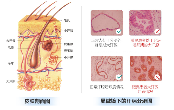 春季如何防治腋臭，做对这三步