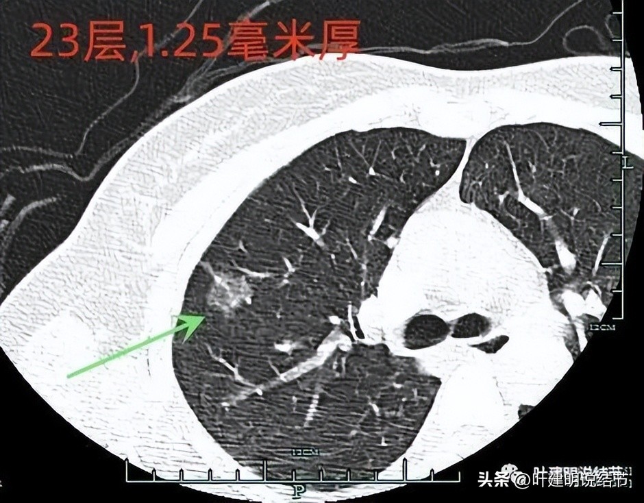 磨玻璃结节伴有增生是癌症吗,磨玻璃结节会是别的癌转移的吗