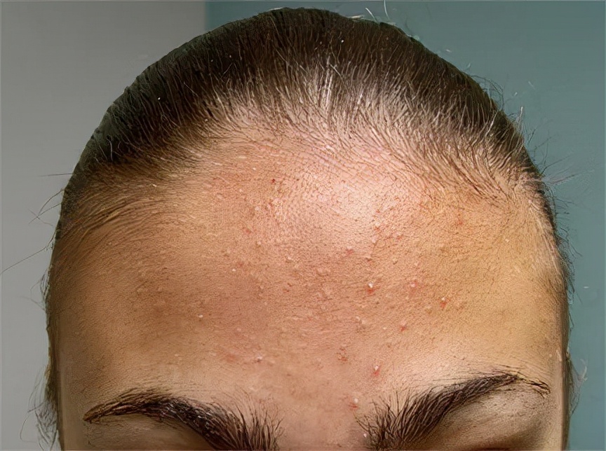 问题肌36计:4大级别痘痘如何对抗你知道吗?调理代谢很重要