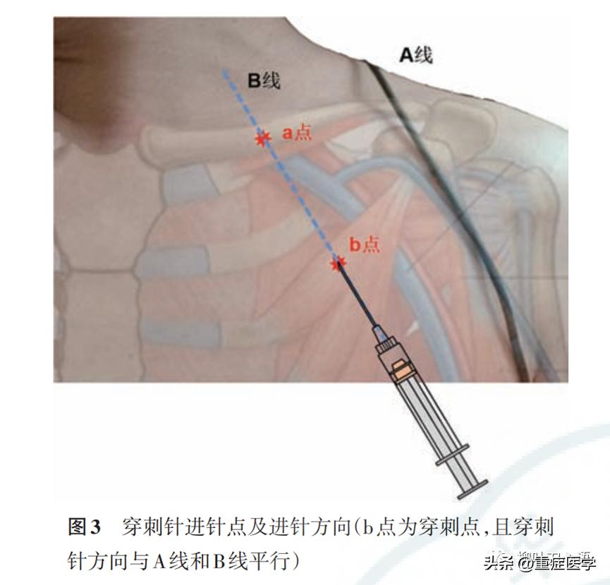 浅静脉穿刺术示范,腋静脉穿刺术