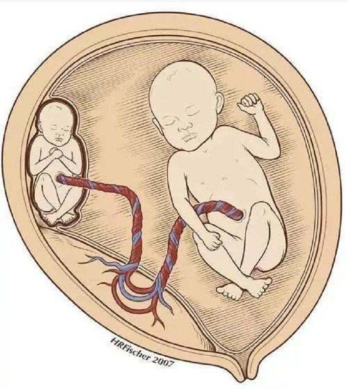 印度女子产下罕见胎中胎,胎中胎真实案例印度