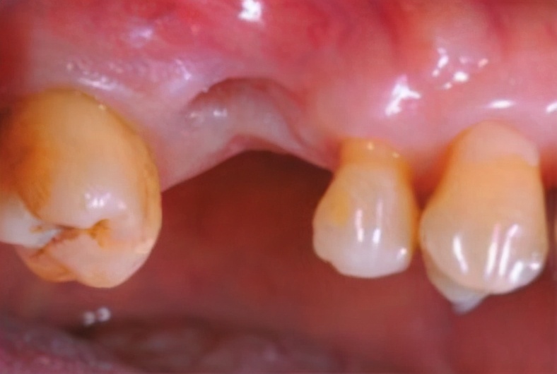 拔牙坑里面会有食物残渣怎么办,拔牙以后那个坑怎么清洁