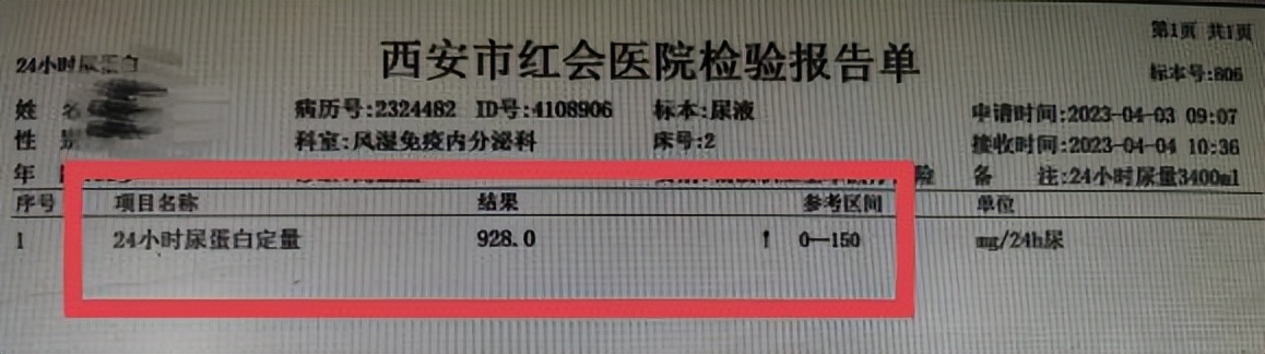 系统性红斑狼疮早发现好控制吗,系统性红斑狼疮治得好不