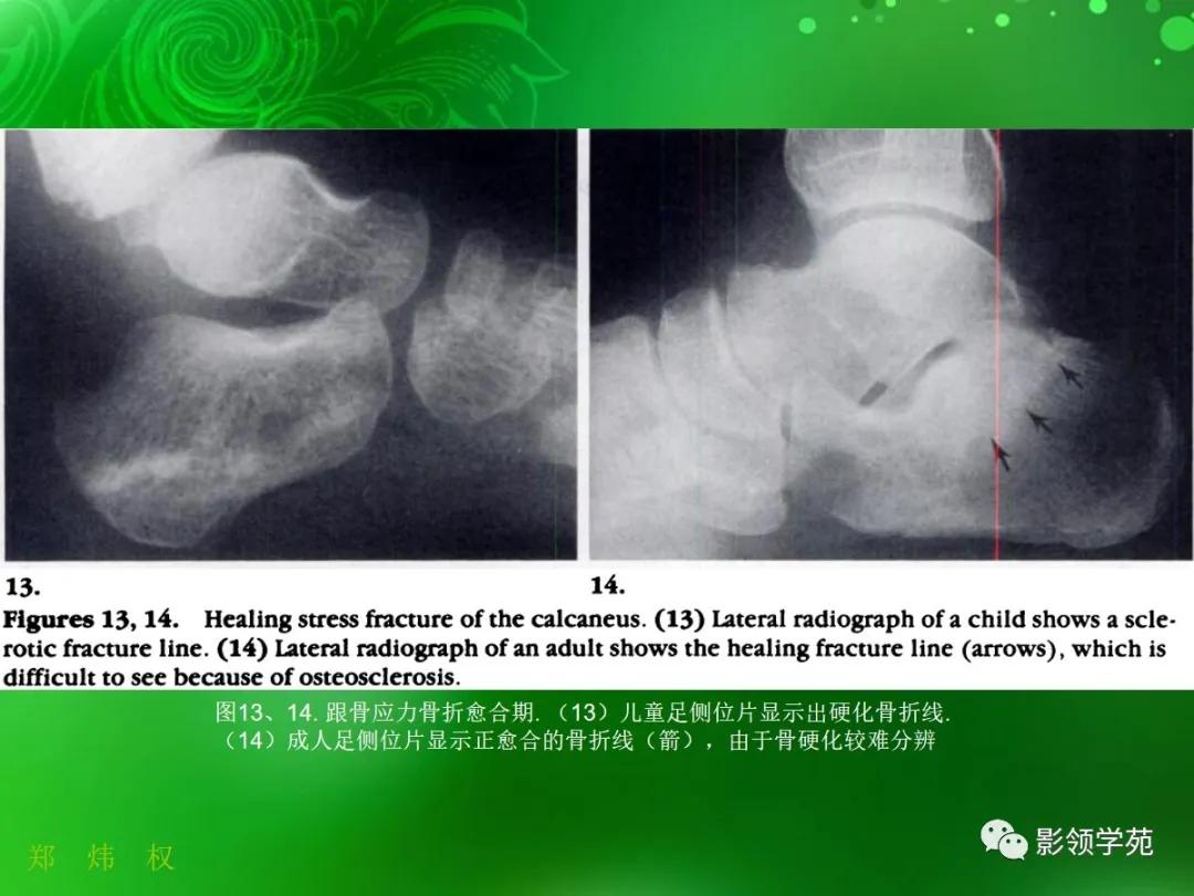正常跟骨影像图,跟骨正常与变异影像表现图片