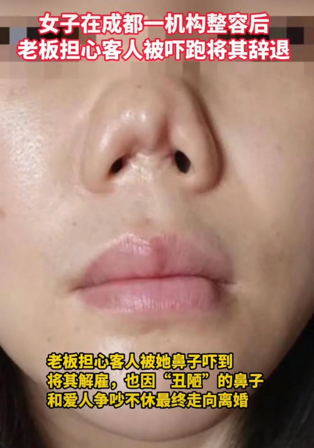 猪鼻子整容,女子花四万整容结果嘴巴歪了