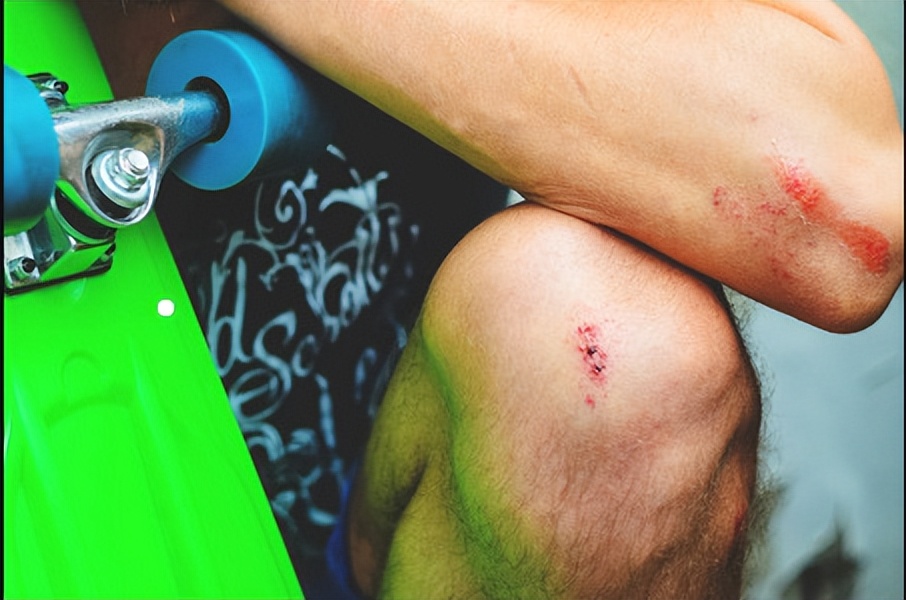 运动受伤应急处理动画,运动受伤的处理方法