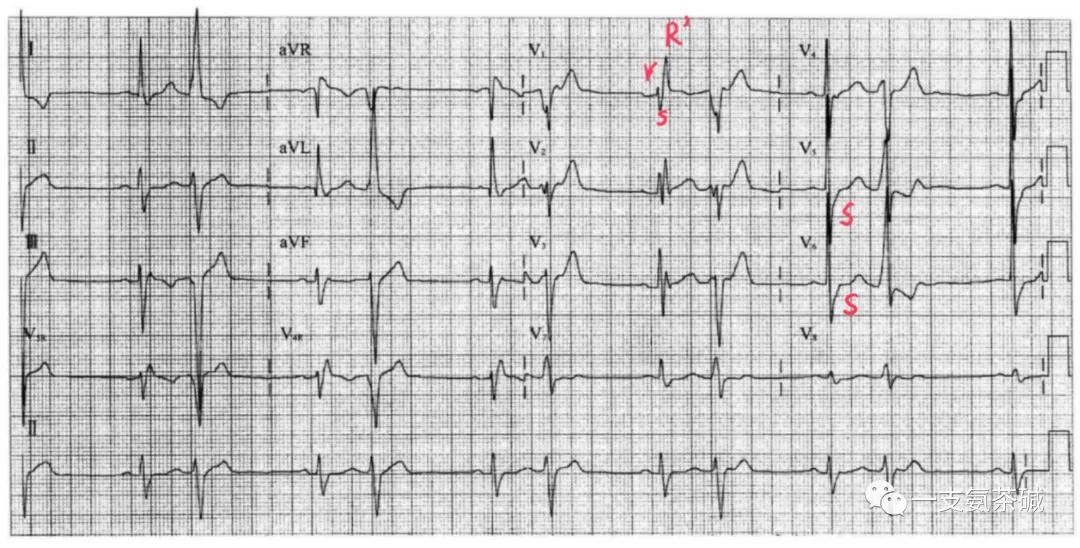 心电图临界异常右束支传导阻滞,心电图十二导和十八导