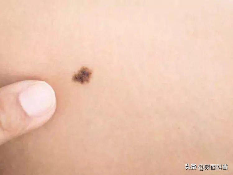 鼻子上的黑头的正确处理方法,鼻子上的黑头大家都是怎么解决的