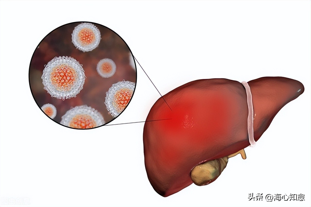 化疗肝损伤多久能保肝恢复,化疗引起的肝损伤吃什么药