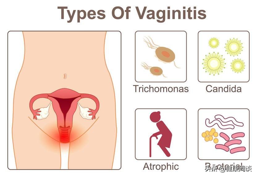 提醒女性：治疗阴道炎需注意这4个事项，否则病情易反复