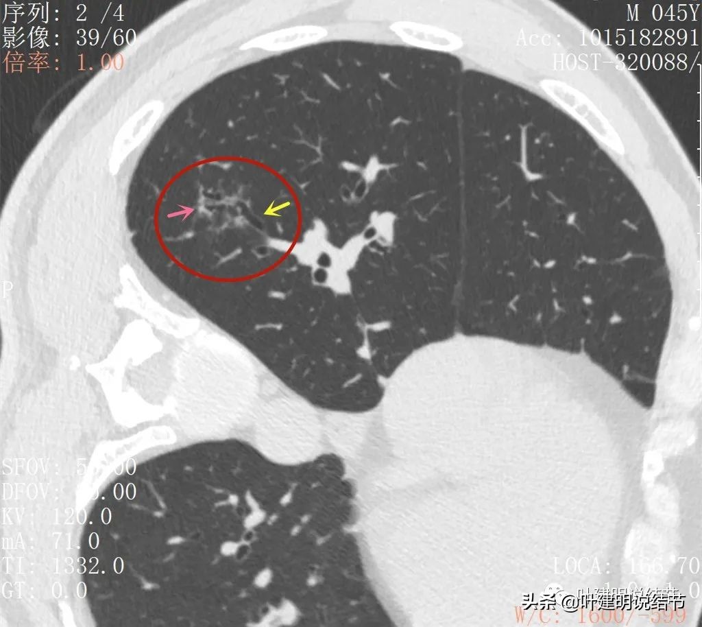 误诊肺纤维化,肺蜂窝状是癌吗