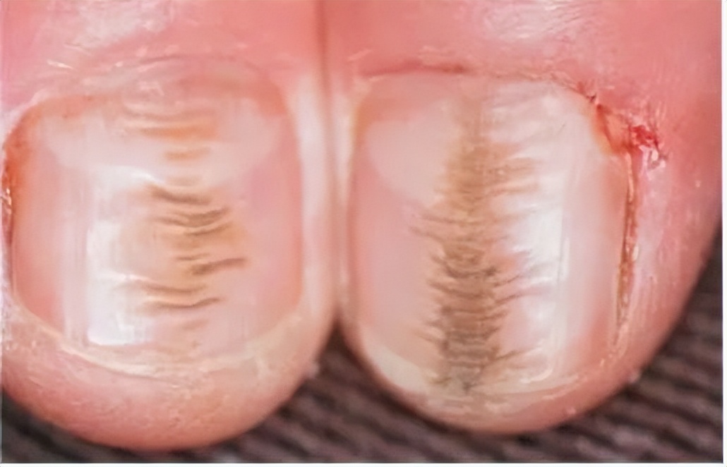 指甲上有黑线的预兆,指甲上有小黑线要注意哪些