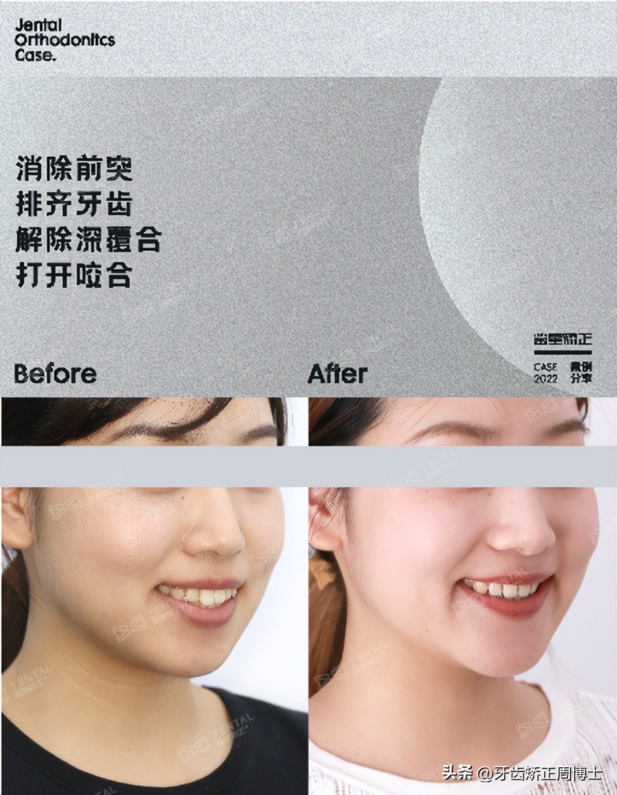 低角面型下巴前倾正畸案例,露龈笑嘴凸下巴后缩