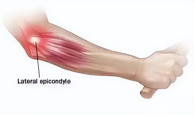 在做冲击波治疗前可以打封闭吗,冲击波治疗网球肘有效吗