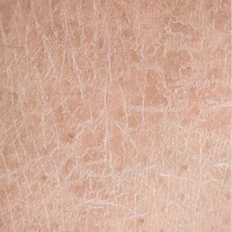 秋冬脸上皮肤干燥起皮怎么用面霜,秋冬脸部干燥起皮刺痛