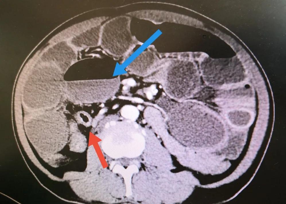 腹腔镜下结肠癌根治术,腹腔镜下结肠癌根治术手术步骤
