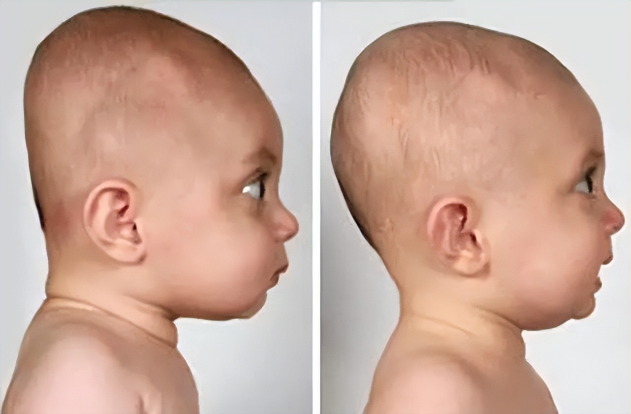 扁头有多毁颜值,扁头对颜值影响有多大