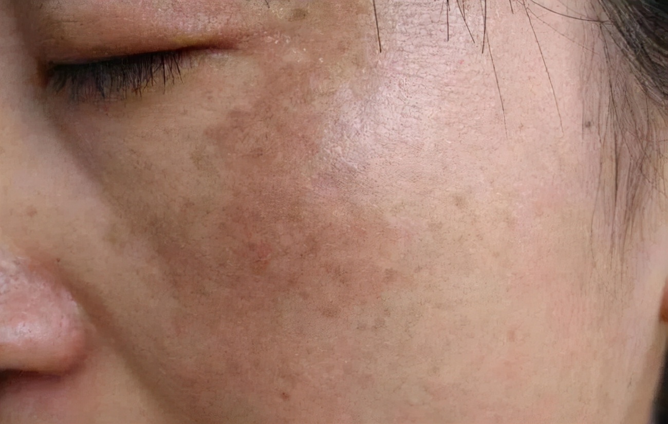 医美皮秒真的可以祛斑吗,轻医美祛斑效果是真的吗