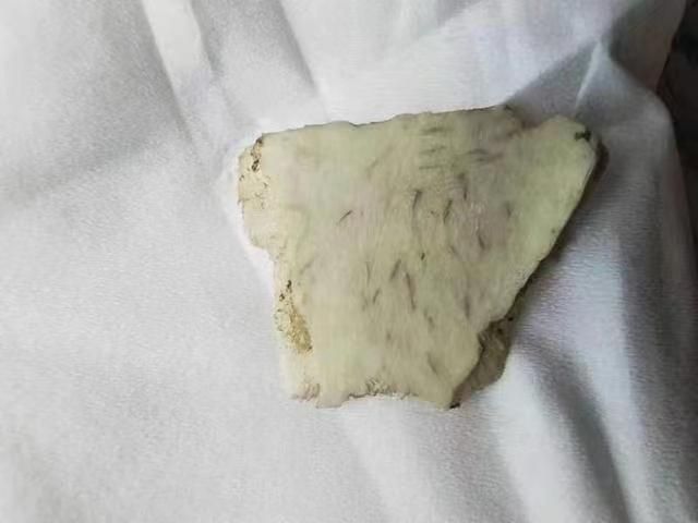 安塞区人民医院：“镜”艺求精巧取羊骨