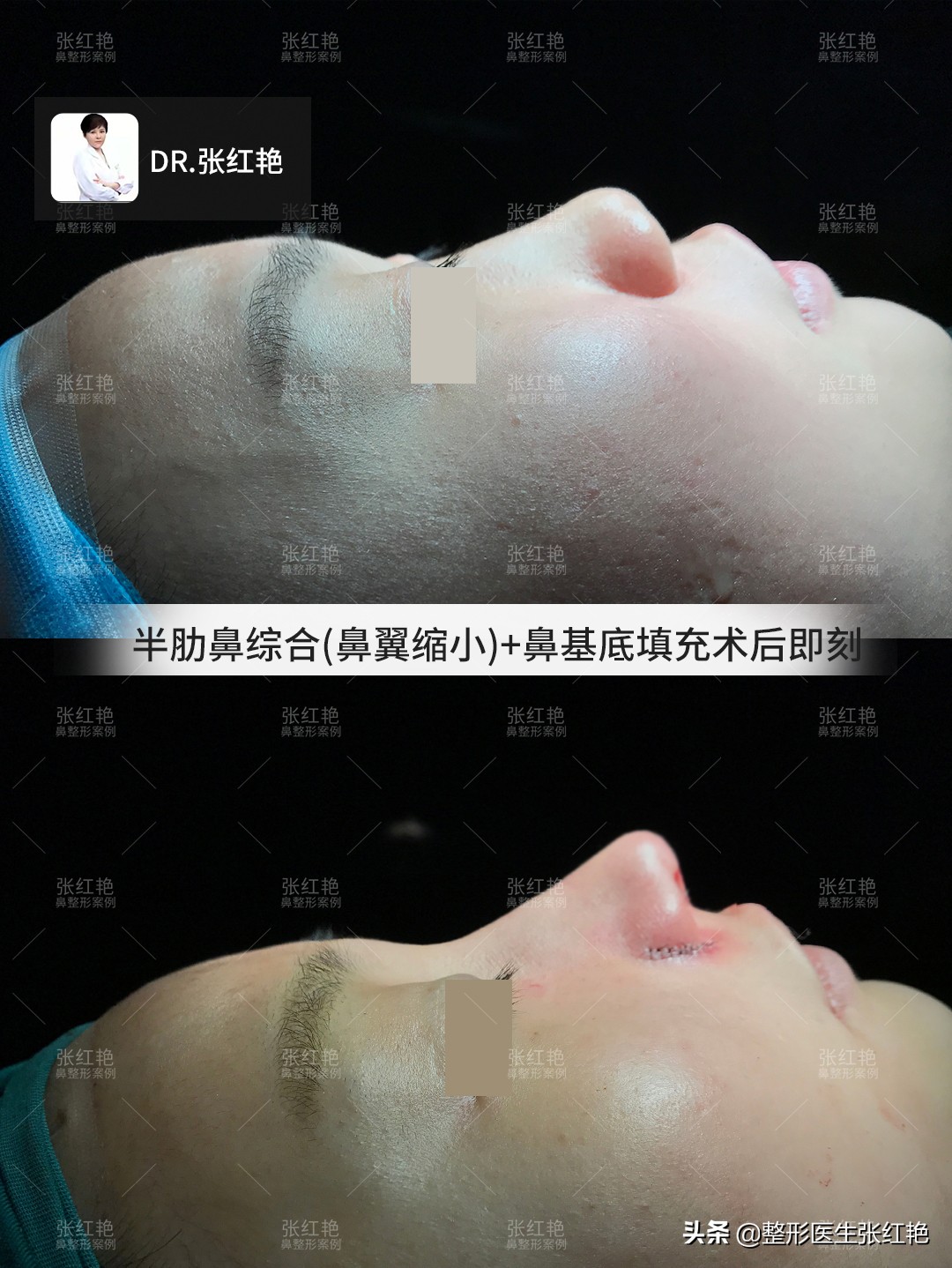 整容鼻子成功案例,鼻子整形有哪些鼻子形状