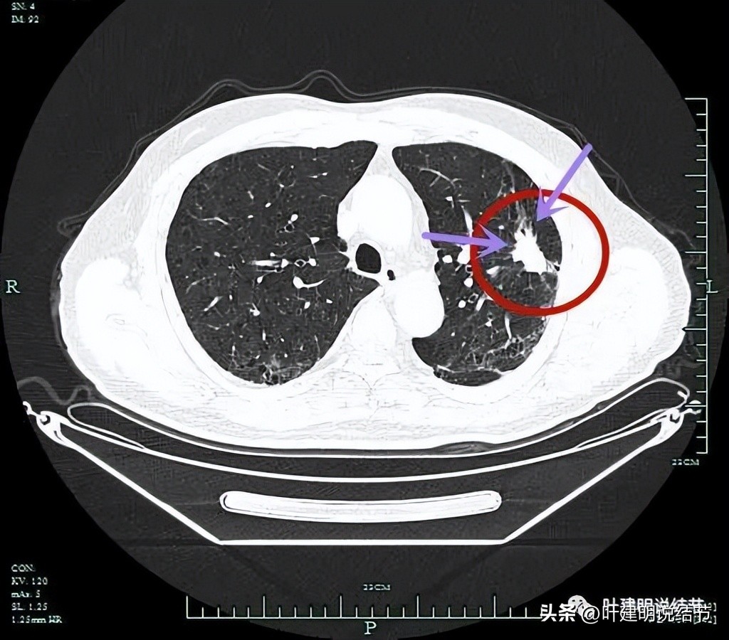 pet判断淋巴结转移,petct判断癌有没有转移准确吗