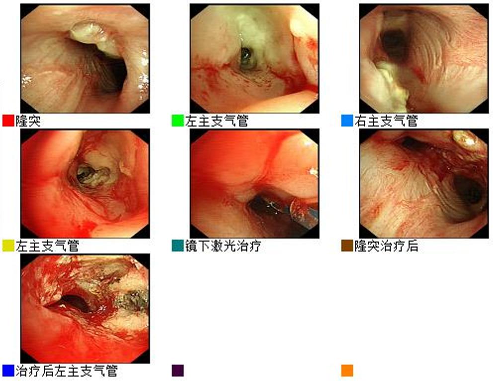 男23岁因上呼吸道感染剧烈咳嗽,34岁小伙咳嗽一个星期了